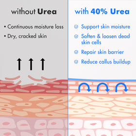 Ebanel before and after callus comparison showing smoother skin