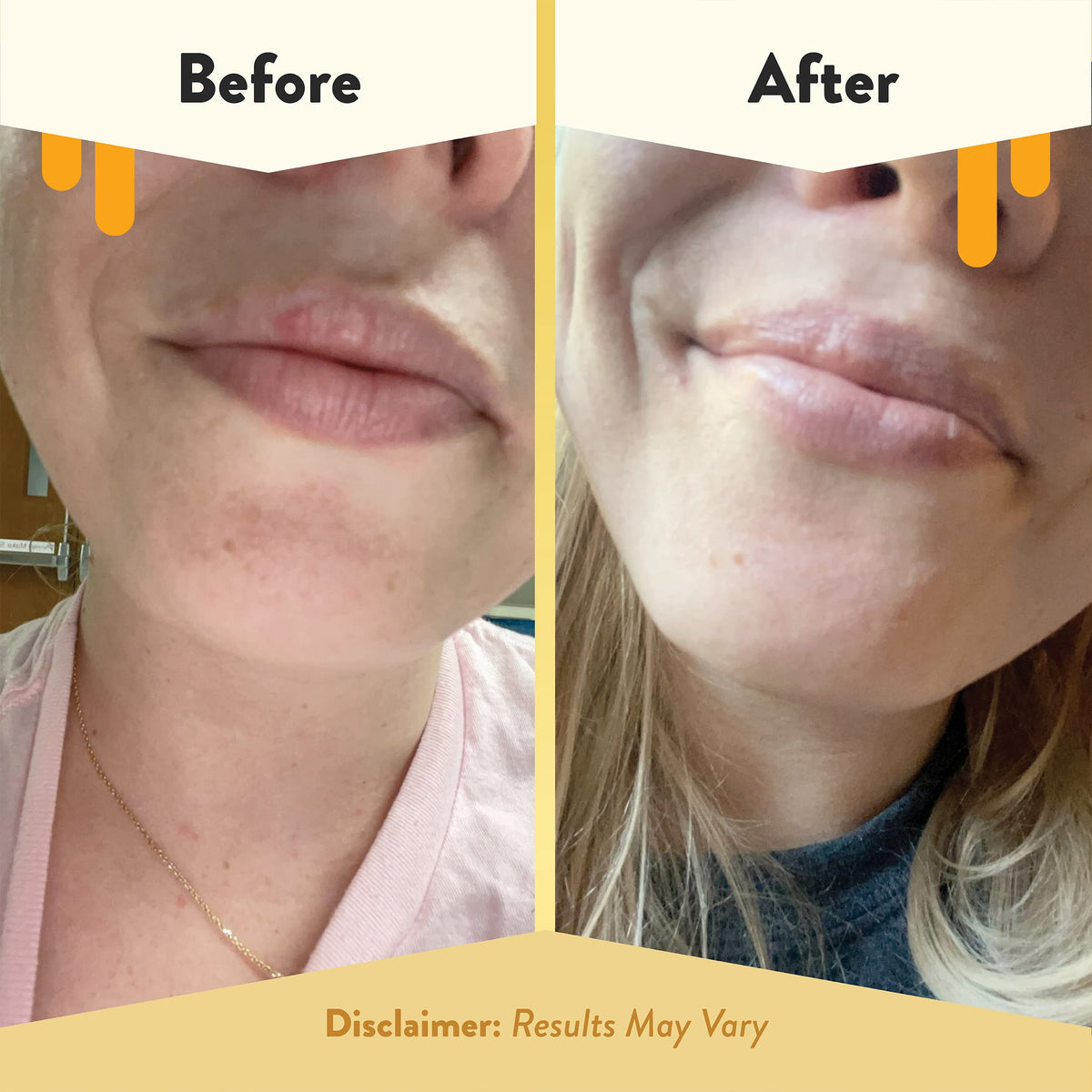 ECZEMA HONEY applied on lips outdoors demonstrating protective, non-greasy wear