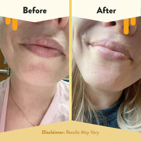 ECZEMA HONEY applied on lips outdoors demonstrating protective, non-greasy wear