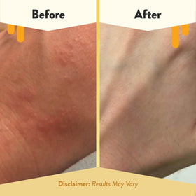 ECZEMA HONEY applied on hand illustrating immediate hydration and reduced dryness after use