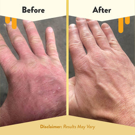 ECZEMA HONEY bottle on bathroom counter suggesting everyday use