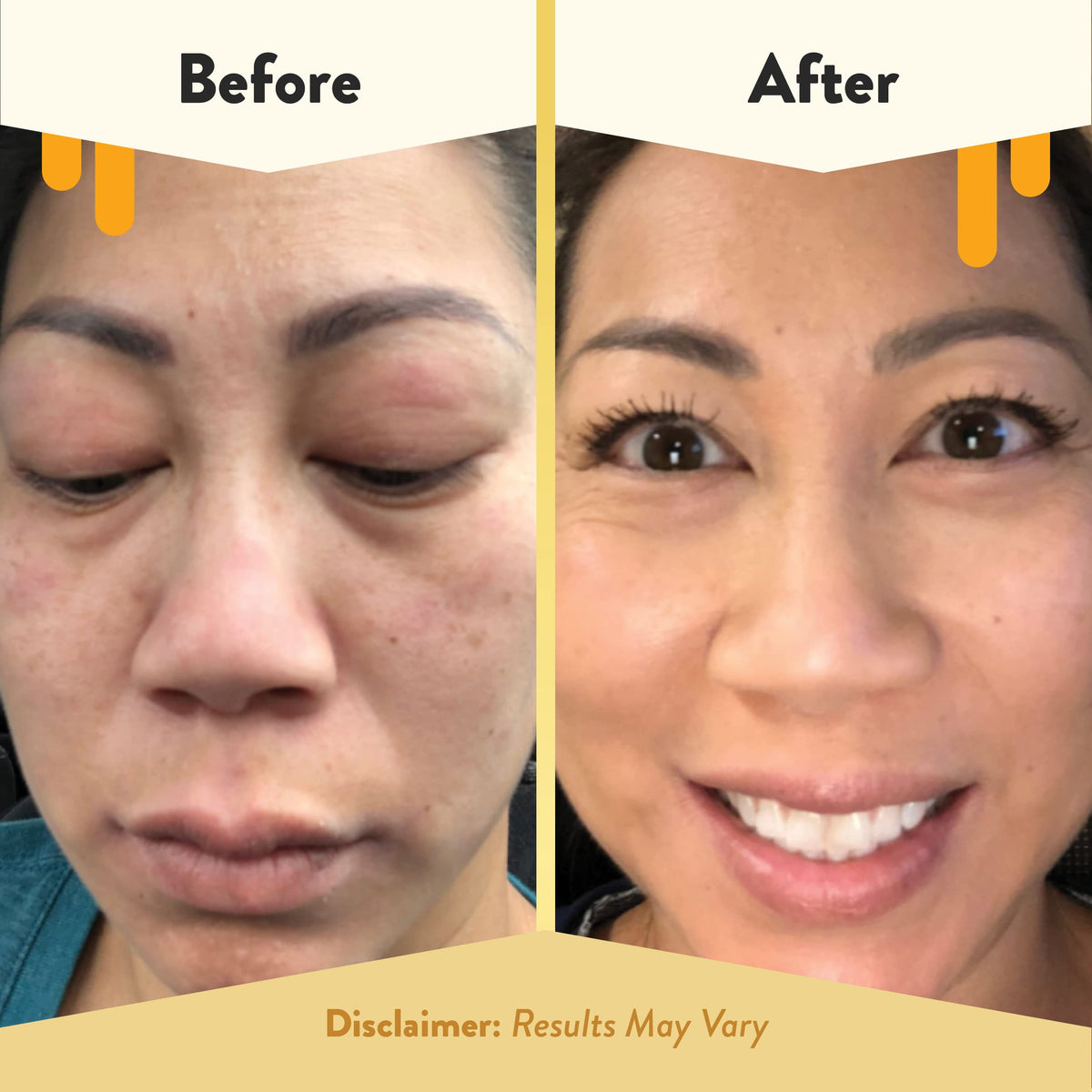ECZEMA HONEY dabbed on lips and eyelid showing gentle targeted relief