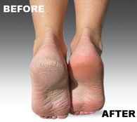 Emjoi roller snapped into Micro-Pedi device demonstrating instant performance benefit