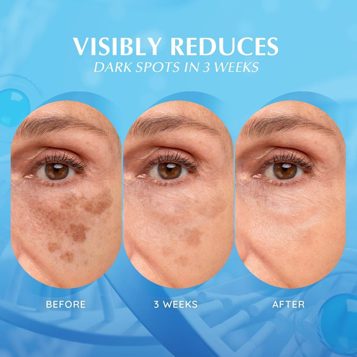 EnaSkin before and after spot comparison showing reduced dark spot visibility