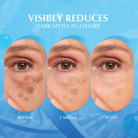 EnaSkin before and after spot comparison showing reduced dark spot visibility
