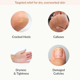 Epielle gloves in use on hands delivering fast softening and relief