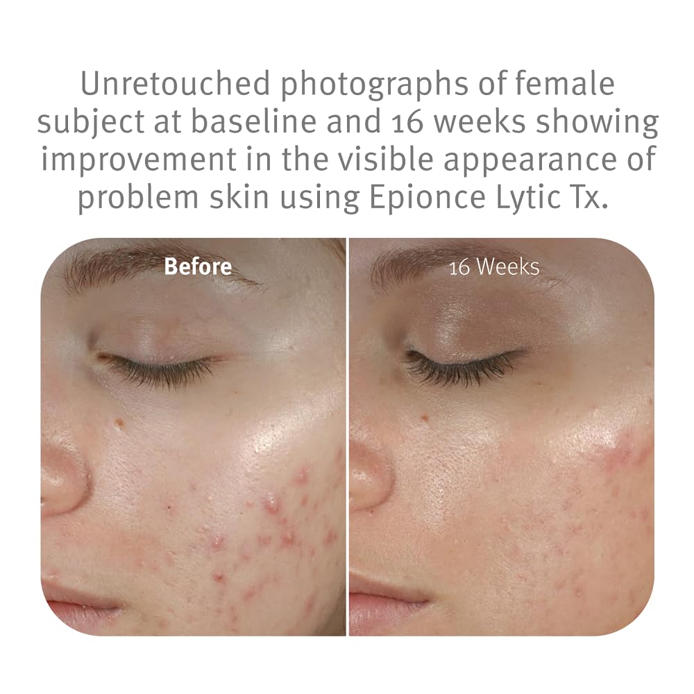 Epionce Lytic Tx ingredients label highlighting salicylic and azelaic acids and benefits
