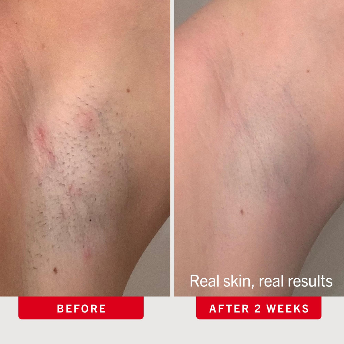 First Aid Beauty pad being gently swiped on underarm to reduce bumps