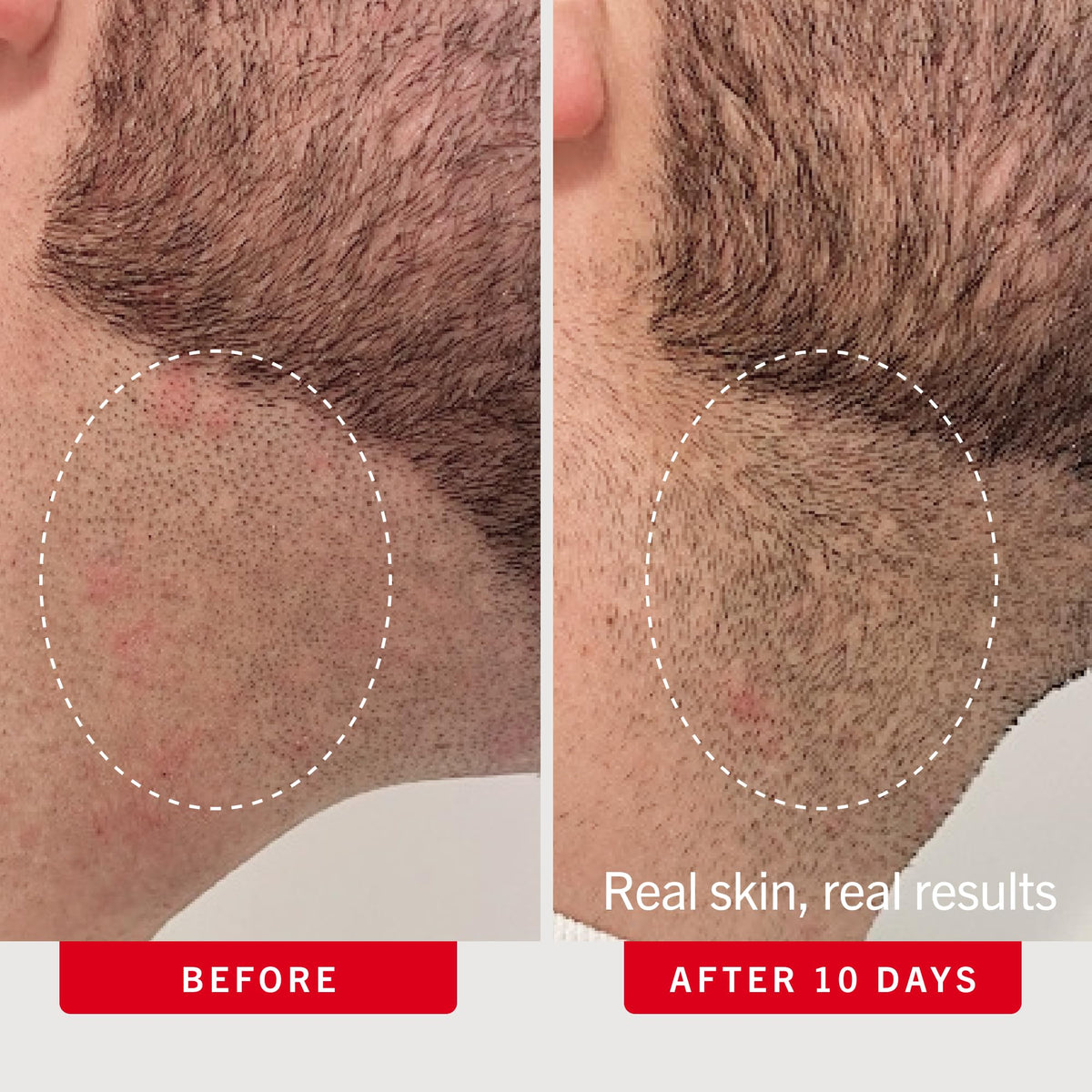 First Aid Beauty pad being applied to underarm to reduce razor bumps