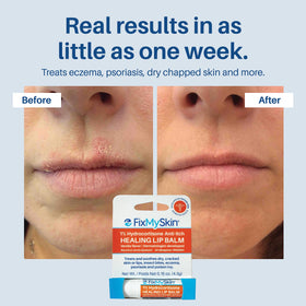 FixMySkin applicator tip detail for precise, mess-free soothing application