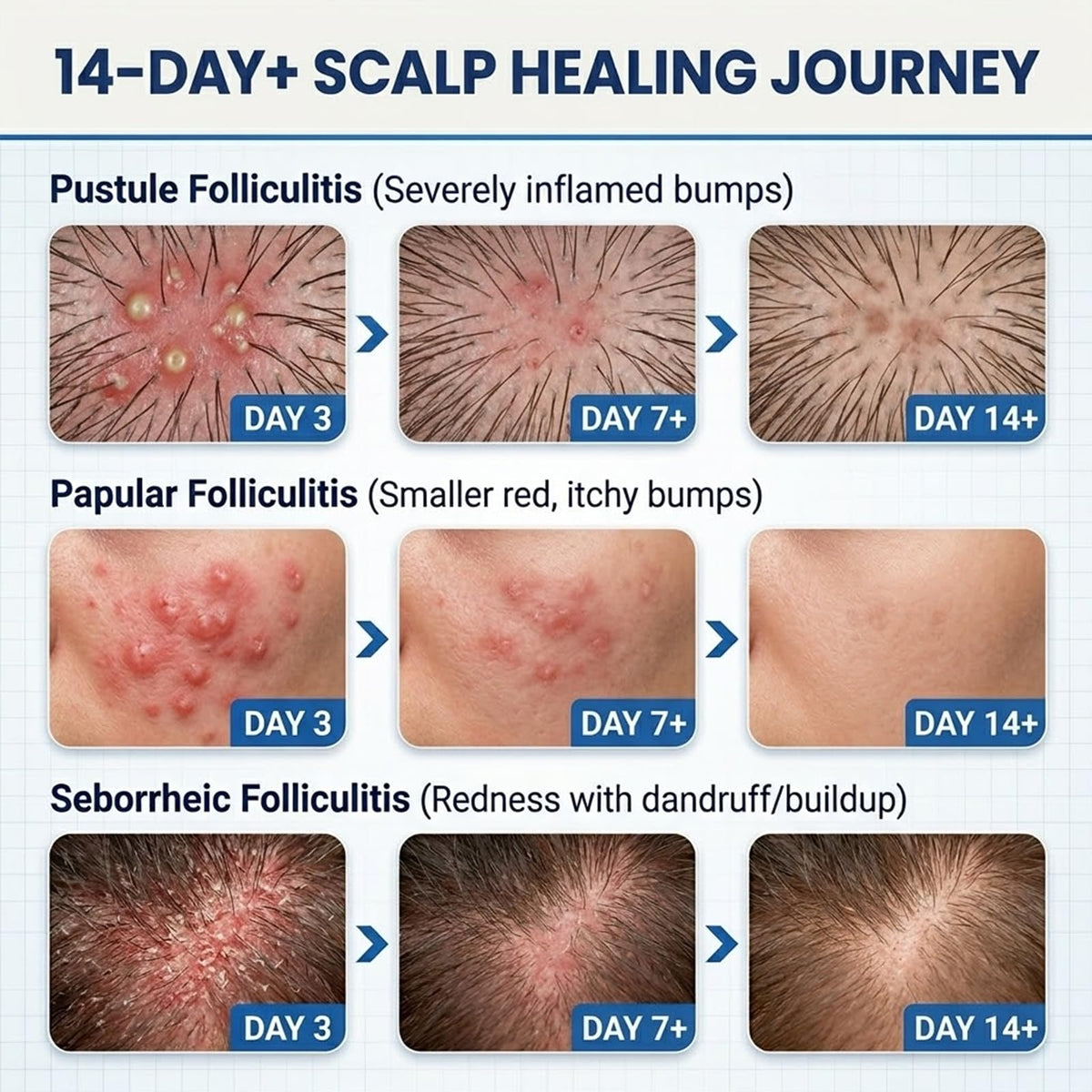 FLYLEAF applied to scalp bump illustrating targeted relief and cooling