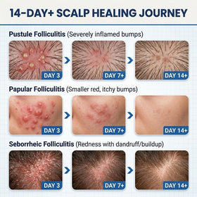 FLYLEAF applied to scalp bump illustrating targeted relief and cooling