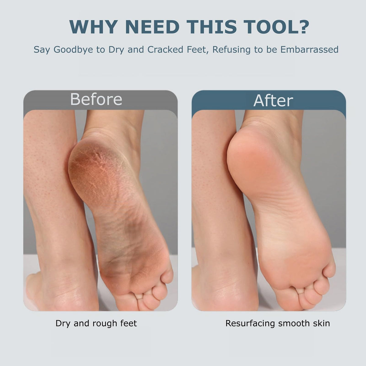Fooseey device in use on heel illustrating safe callus removal at home