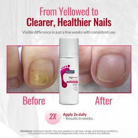 FOOTLOGIX close-up of nail texture after application showing smoother conditioned finish