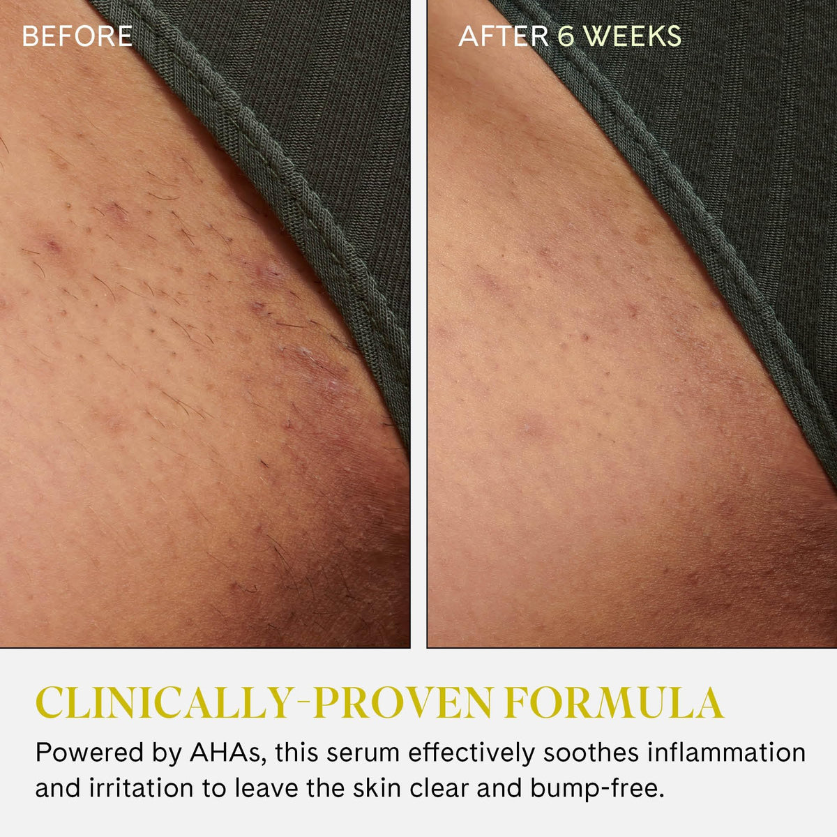 Fur rollerball being applied to bikini line to reduce bumps and redness