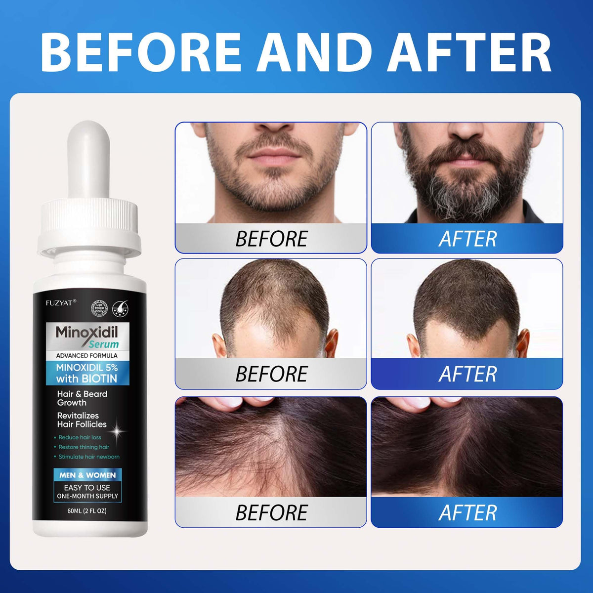 FUZYAT application on scalp demonstrating easy twice-daily use benefits