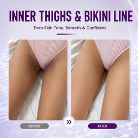 Ganrek cream applied underarm demonstrating targeted dark spot care