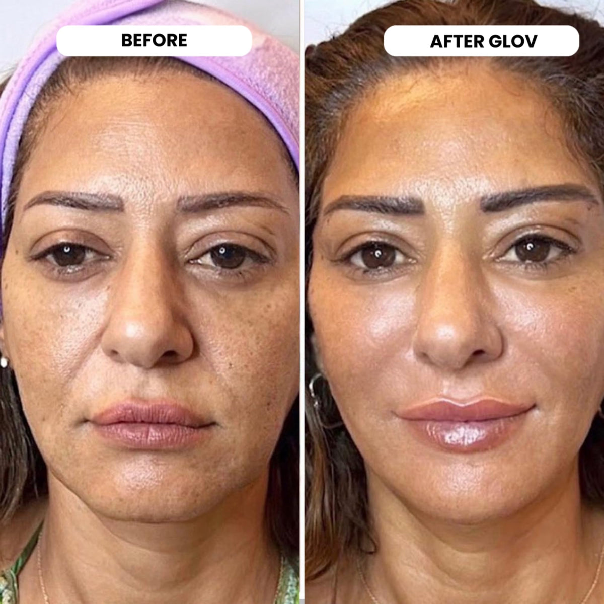 Glov Beauty applicator being filled with serum for easy at‑home use