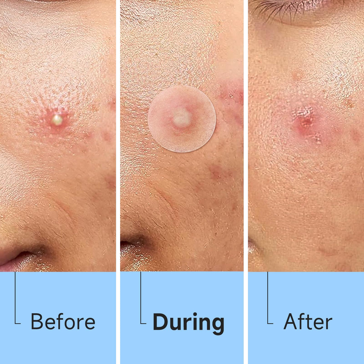 Glowpatch clear patch adhered to skin detail providing discreet protection