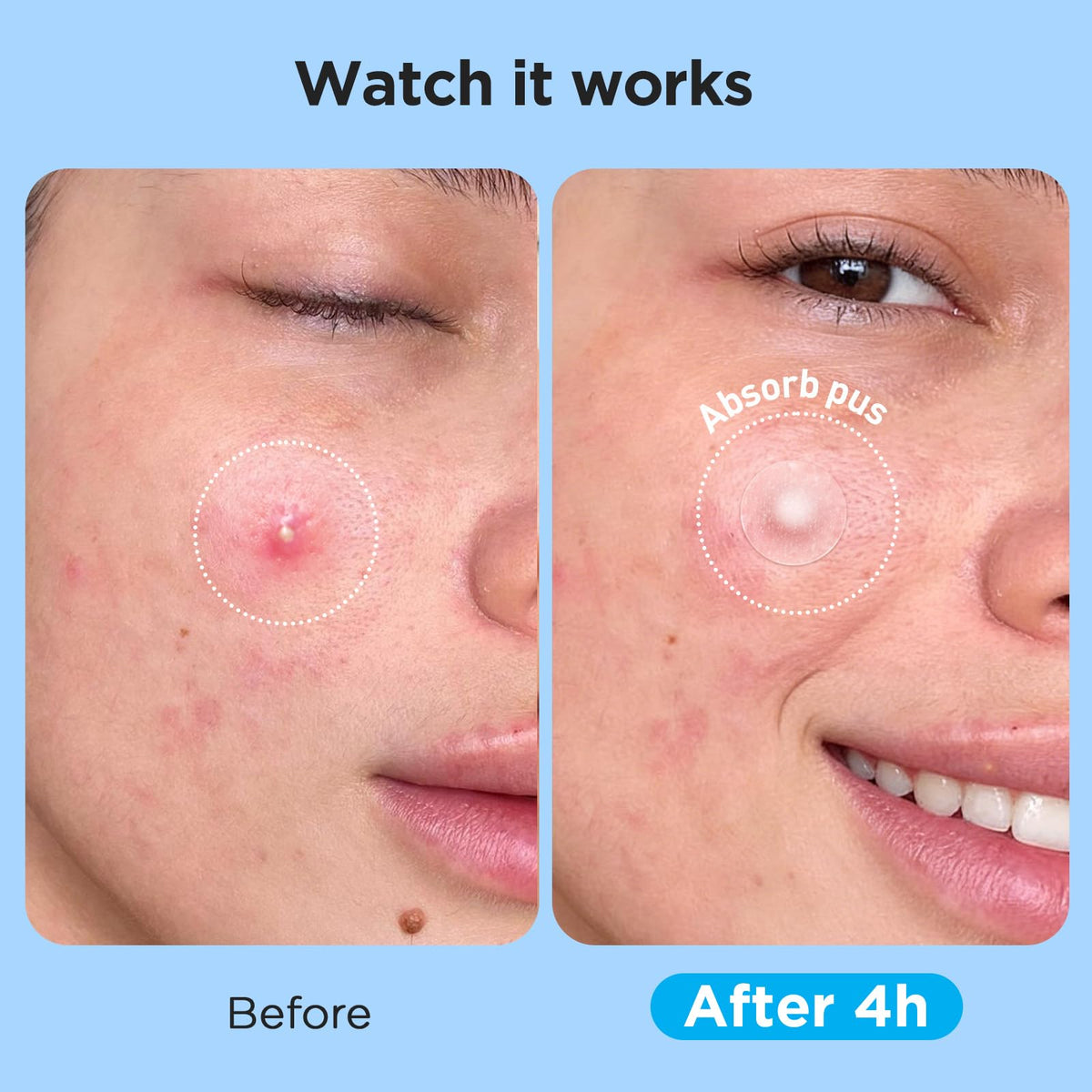 Glowpatch multiple sizes applied on skin demonstrating right-size coverage