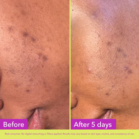 Good Molecules patch applied to cheek demonstrating targeted delivery and secure wear