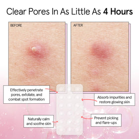 grace & stella patch applied to cheek on model, protects blemish and stays invisible
