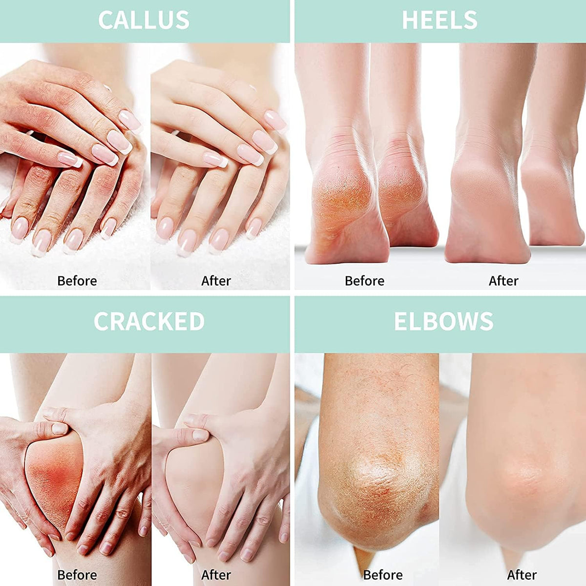 Grocerism applied to heel in-use, showing targeted callus softening benefit