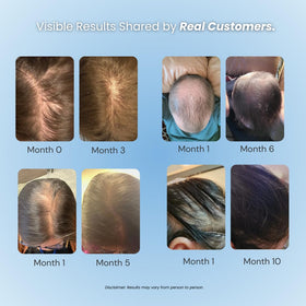 GROWPLEX applied to thinning scalp illustrating targeted coverage benefit