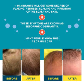 Happy Cappy product label highlighting active ingredients for dandruff relief