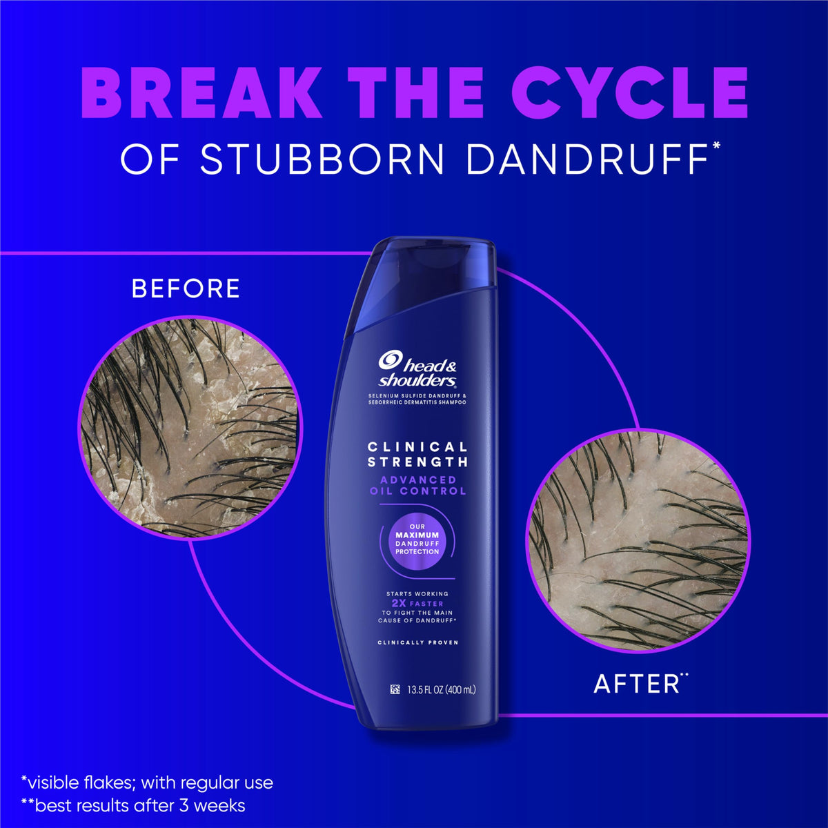 Head & Shoulders clinical shampoo lather texture demonstrating effective cleansing