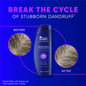 Head & Shoulders clinical shampoo lather texture demonstrating effective cleansing