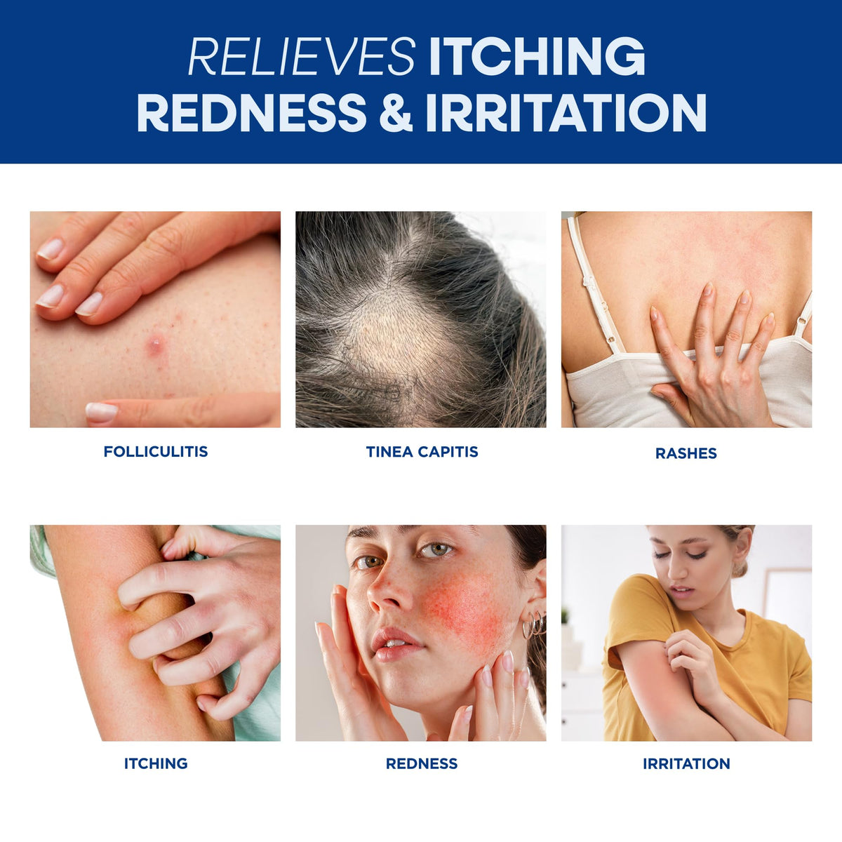 Hermon cream being applied to facial area for targeted soothing benefit