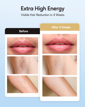 INNZA device in use on leg demonstrating smooth hair reduction
