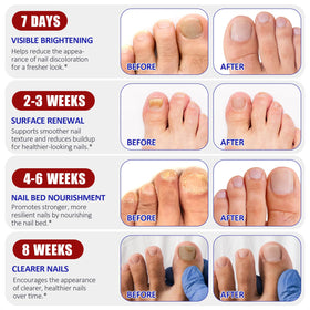 IRSRDOQU worn overnight on toe demonstrating discreet protection and improved appearance