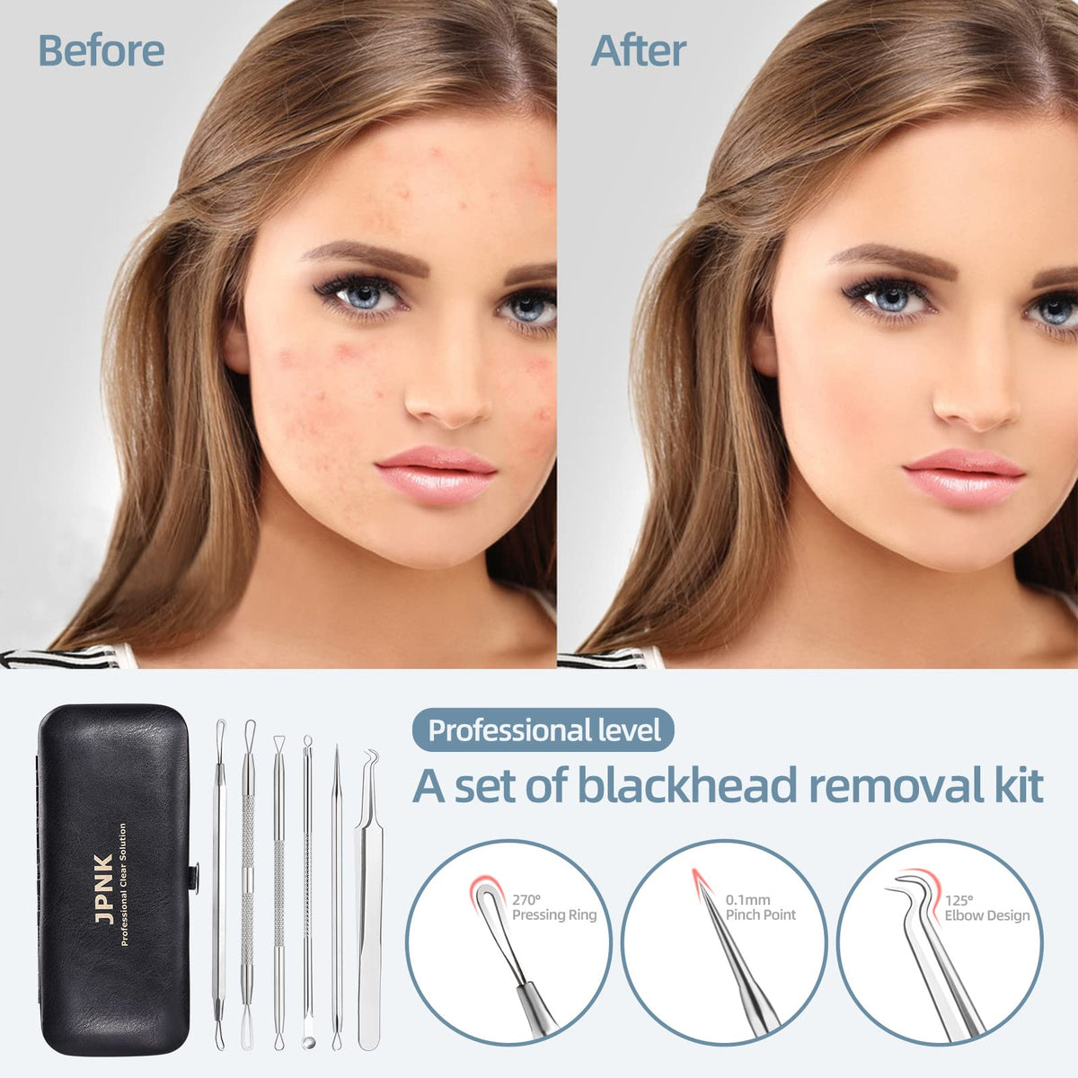 JPNK close-up of loop tip demonstrating smooth edge for even blackhead extraction and safety