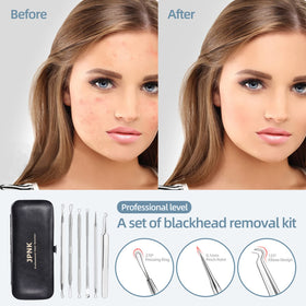 JPNK close-up of loop tip demonstrating smooth edge for even blackhead extraction and safety