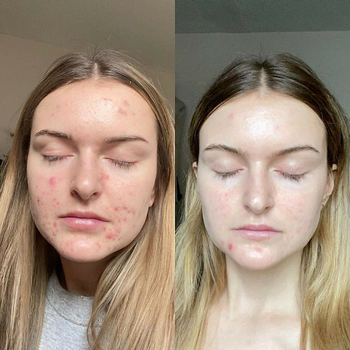 K6 Skin Care before and after comparison showing improved texture and reduced spots
