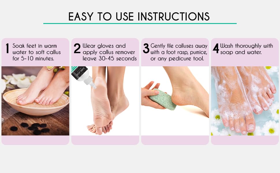Karlash gel applied on foot with pumice stone in hand demonstrating easy callus removal