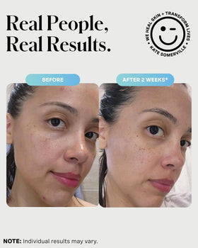Kate Somerville used as a short-contact sulfur mask on breakout area to target blemishes benefit