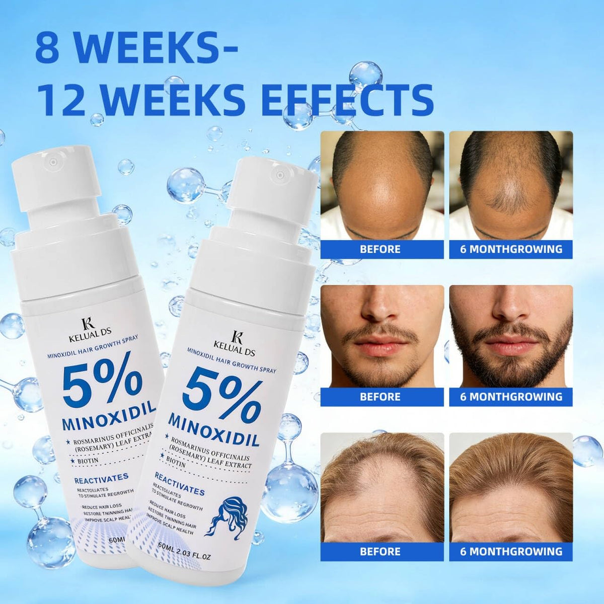 KELUAL DS application on scalp focusing targeted treatment area