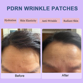 Kewhunt forehead patch applied during sleep demonstrating secure overnight wear