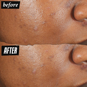 Kiehl's treatment dabbed on fingertip ready to apply to blemish