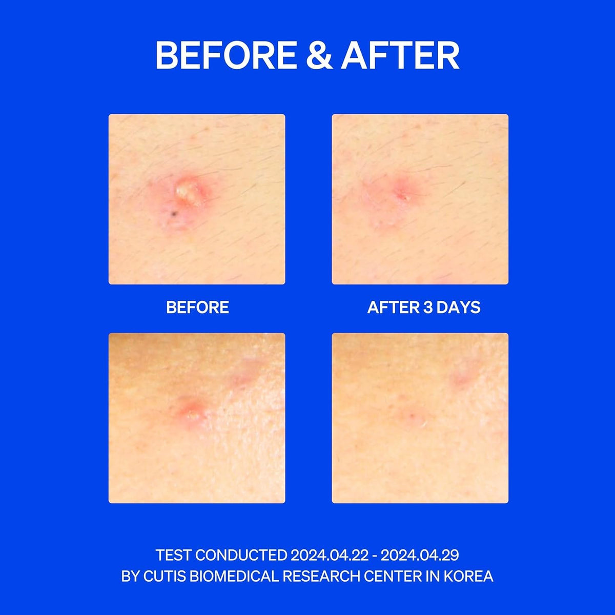 KNEMO SaniTouch two-step demonstration, helps hygienic easy placement