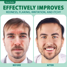 KOPA HAIKU being applied to scalp hairline for targeted relief and lightweight absorption
