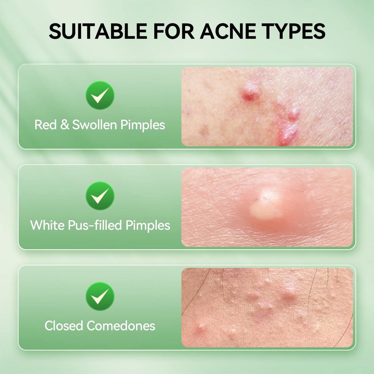 LANBENA precision application using included swab for targeted blemish care
