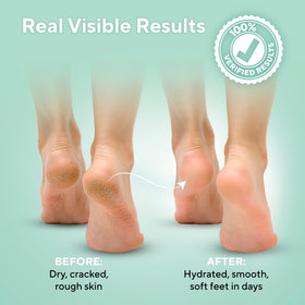 lavinso cream being applied to heel to soften calluses and cracked skin