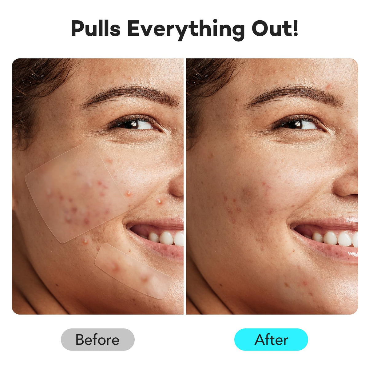 LitBear patch applied to cheek protecting and hiding blemish