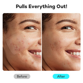 LitBear patch applied to cheek protecting and hiding blemish