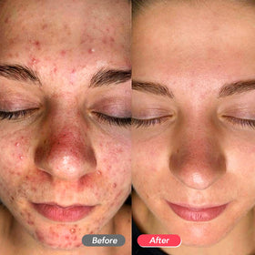 LitBear tool in hand targeting nose blackheads, controlled extraction benefit