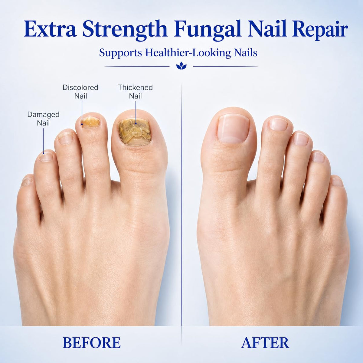 Lyssera pen held by hand applying along a toenail edge for accurate daily use